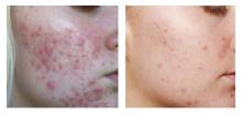 accumax anti acne voedingssupplmenet