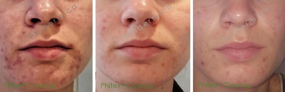 Phitex acne clear up