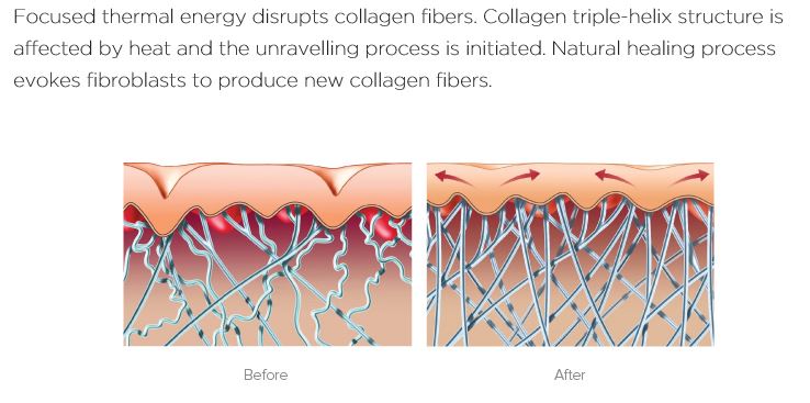 collagen refill process